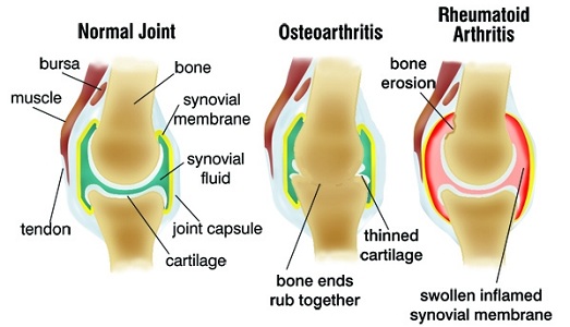 Osteoarthritis Vs Rheumatoid Arthritis Similarities And Differences New Health Advisor